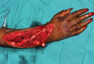 Arm-wound-with-exposed-tendon-and-bone