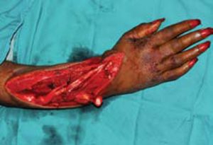 Arm-wound-with-exposed-tendon-and-bone